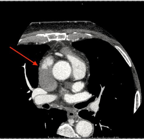 Ct Image Of Invasion And Occlusion Of Superior Vena Cava Extending Up Download Scientific