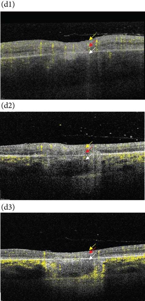 Ae Active Recurrent Toxoplasma Retinochoroiditis In A Yo Woman