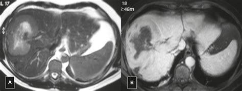 Scielo Brasil The Many Faces Of Primary And Secondary Hepatic