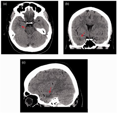 Reversible Temporal Hypodensity On Ct In A Patient With Minor Head