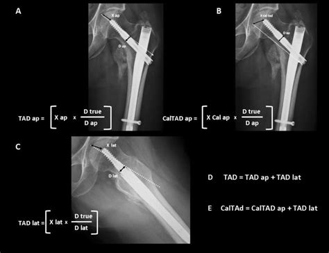 A Tip Apex Distance Calculated On Anteroposterior Radiograph Tad