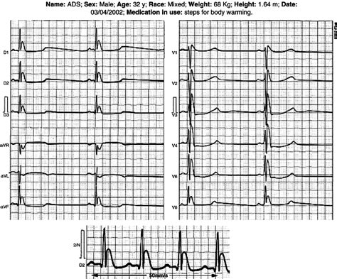 Hypothermia Ecg