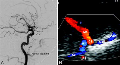 Transcranial Color Coded Duplex Sonography For Detection Of Distal