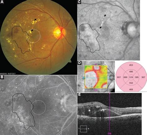 Classification Of Fundus Autofluorescence Abnormal Patterns In Diabetic