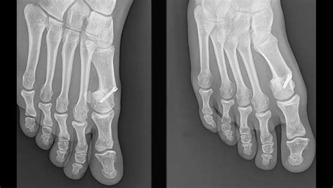 Hallux valgus Operation Orthopäde Wien Dr Hüthmair