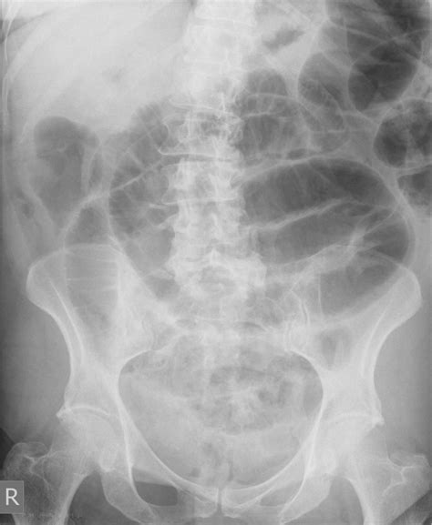 Free Intraperitoneal Gas Riglers Sign Confirming The Intraperitoneal