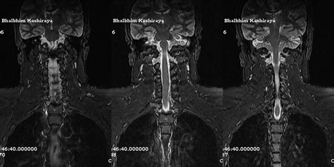 Dr Balaji Anvekar Frcr Spinal Epidural Lesion Mri