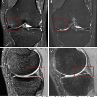 Magnetic Resonance Imaging Evaluation Of Bone Marrow Lesions And