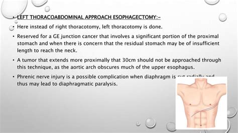 Ivor Lewis Esophagectomy PPT