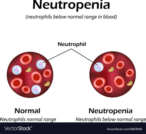 Neutrophils below the normal range in the blood Vector Image