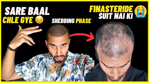 Shedding Phase After Hair Transplant Youtube