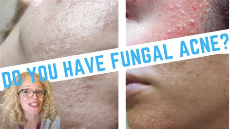 Update How To Clear Fungal Acne Natural Methods The Ultimate