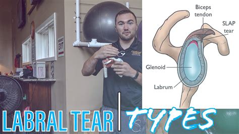 Torn Labrum Labral Tear Types And Prognosis Youtube