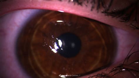 Erosio Cornea Atlas Der Augenheilkunde