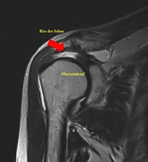 Therapiemethoden Physiotherapie Ruptur Der Supraspinatussehne