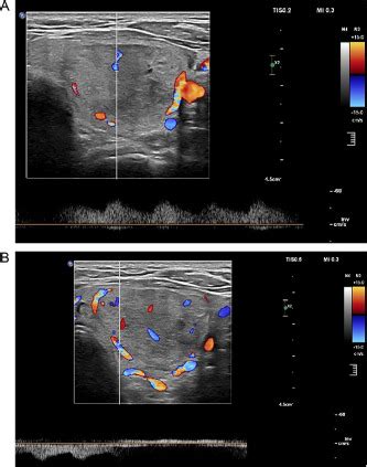 Advanced Techniques For Thyroid Nodule Radiofrequency Ablation