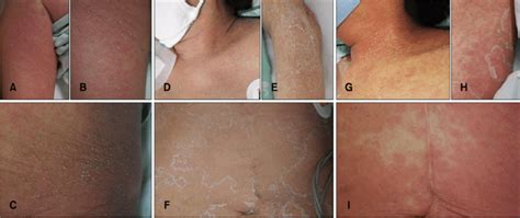 Diffuse Erythematous Eruption With Nonfollicular Pinhead Sized Pustules