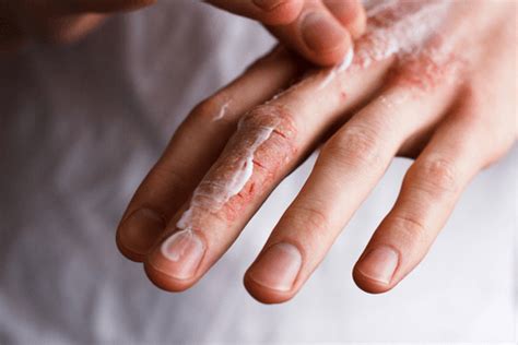 Skin Irritation : Overview, types, causes, symptoms, & treatment | FactDr