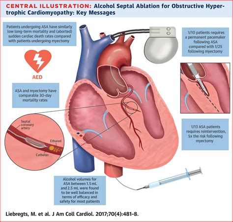 Alcohol Septal Ablation ASA Golden Shutter Films