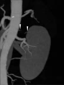 Detectability Of Renal Arteries In Living Renal Donors Using Multi