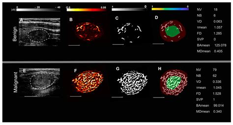 Cancers Free Full Text Quantitative Biomarkers Derived From A Novel Contrast Free Ultrasound