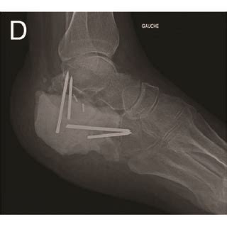 Clinical history: X-ray (a) and CT-scan (b and c) images of calcaneal... | Download Scientific ...