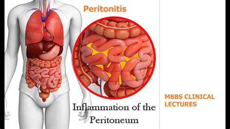 Peritonitis Youtube