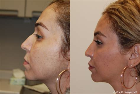 Eric M Joseph Md Silikon 1000 Before And After Non Surgical Rhinoplasty