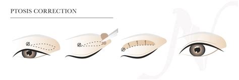 Ptosis Surgery - Nassim Plastic Surgery