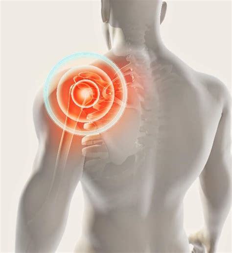 Frozen Shoulder Treatment Chillicothe OH Adhesive Capsulitis Treatment