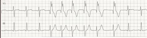 Ekg Rhythm Strips 18 Ventricular Ectopy 1