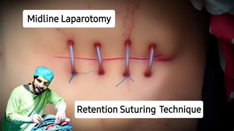 Retention Sutures How To Apply Retention Sutures Dr Tayyab Riaz Ch