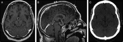 Reversal of Preoperative Catatonic State by Surgical Resecti ...