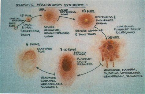 Health & Fitness: Hobo Spider Bite Symptoms