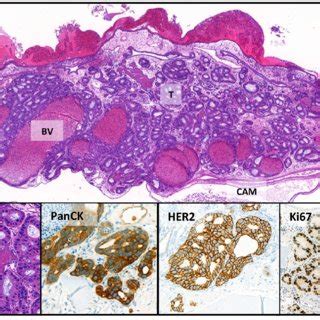 Immunohistochemical Stains Of The Tumor In The Cam Oe Esophageal