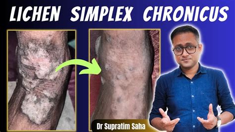 Eczema Lichen Simplex Chronicus Treatment Youtube