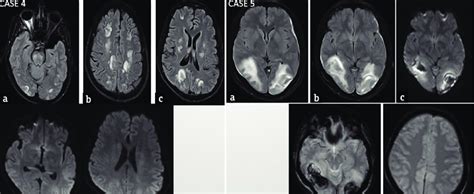 Case A C Hyperintensity In The T Weighted And T Fluid Attenuated