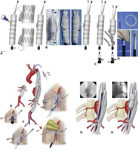 Endovascular Repair Of Large Intercostal Artery Patch Aneurysm Using