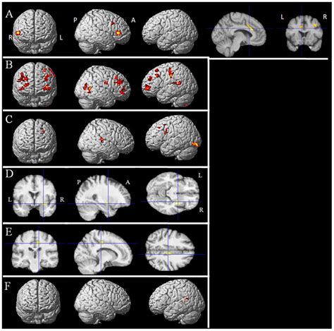 Results Of The Voxel Based Morphometric Vbm Analysis Correlations