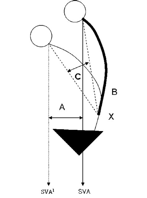 Restoration Of Sagittal Alignment Is Measured By The Distance Between