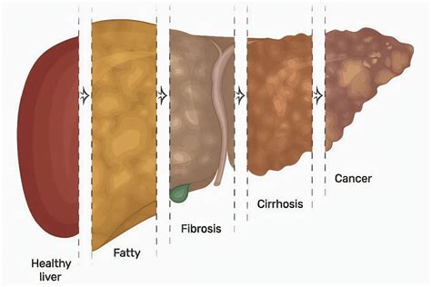 Alcoholic Fatty Liver Disease Understanding Risks And Treatments