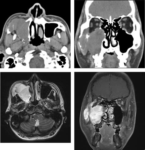 Paranasal Ct And Mri Findings Of Maxillary Sinus Mfh The Figures Show Download Scientific