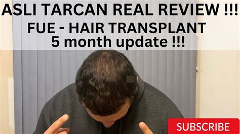 Asli Tarcan Fue Hair Transplant 5 Month Update Real Review