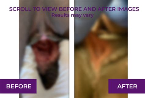 Perineoplasty Before And After Images And Videos Dr Michael Tahery