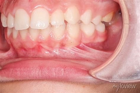 Frontal View Of Dental Maxillary And Mandibular Arches In Occlusion