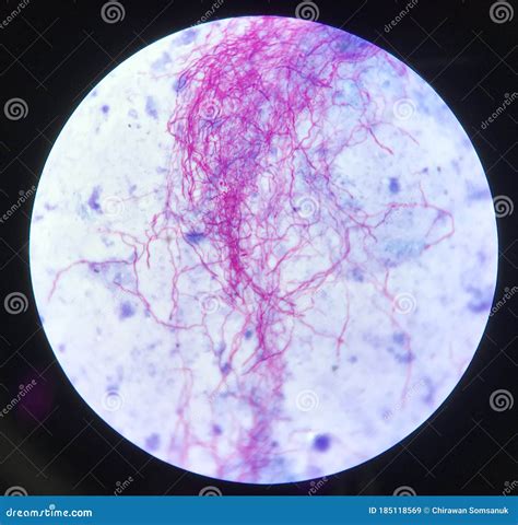 Red Branching Mycobacterium Tuberculosis On Blue Background In Modified Acid Fast Bacilli Stain