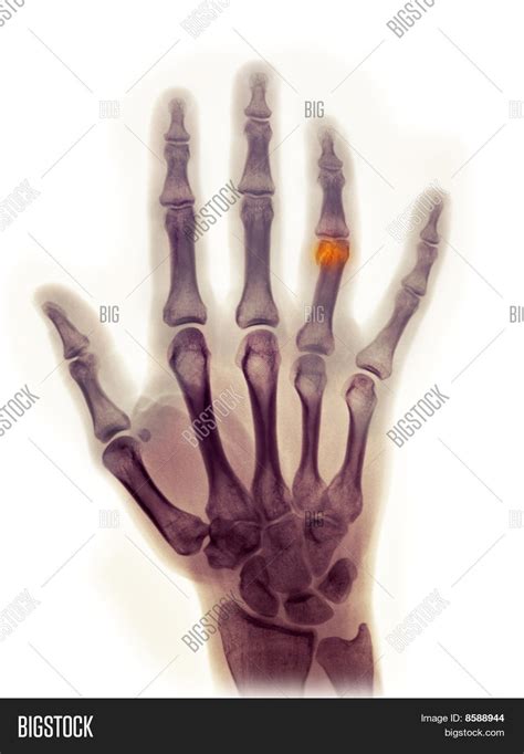 Hand X-ray 23 Year Old Image & Photo (Free Trial) | Bigstock