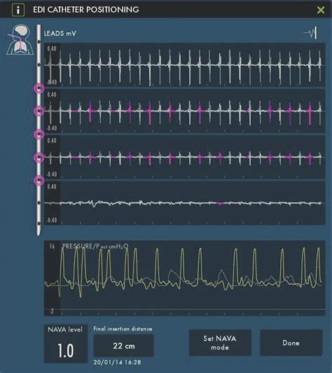 Neurally Adjusted Ventilatory Assist Mode In Pediatric Intensive Care