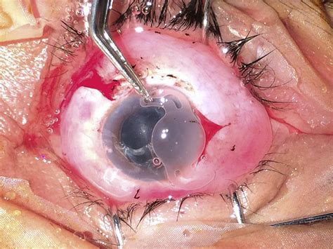 Intraoperative Photograph Showing Explanted Iol Figure Positive Von