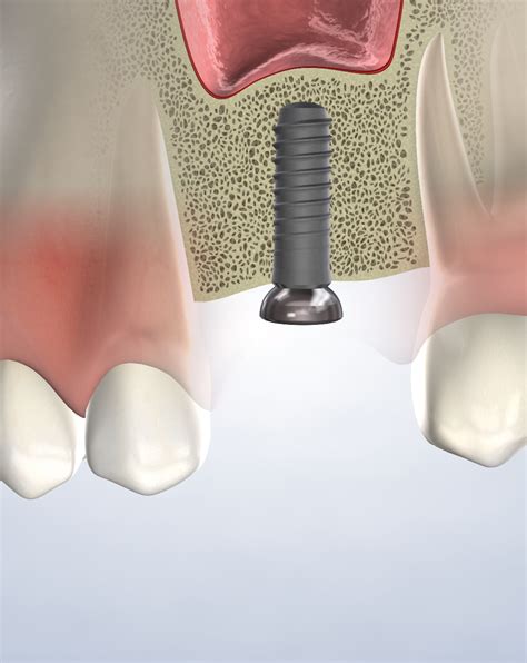 Bone Grafting In Silverdale Poulsbo Port Orchard Wa Kitsap Oral